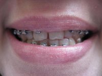 брекеты 0011.JPG