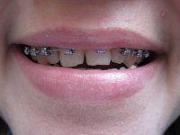 брекеты 0102.JPG