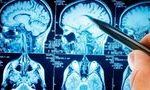 Ученые описали повреждения мозга, связанные с COVID-19 13