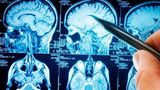 Ученые описали повреждения мозга, связанные с COVID-19 1
