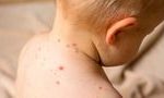 Пандемия коронавирусной инфекции может привести к вспышке кори 15