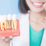 Имплантация зубов, мост или съемный протез? Разбираемся со стоматологом 13