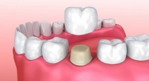 Имплантация зубов, мост или съемный протез? Разбираемся со стоматологом 2