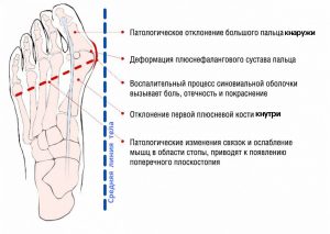 косточка на ноге