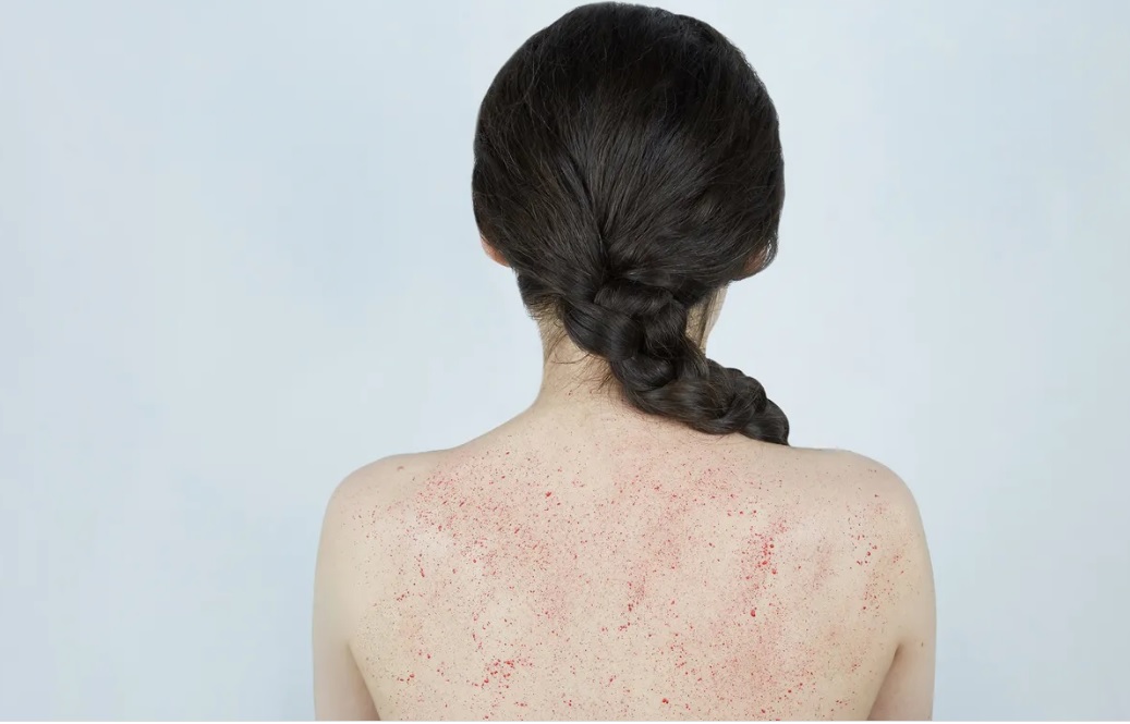 Тромбоцитопения: причины, симптомы, лечение - Форум semeistvo.by