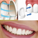 Виниры на Зубы: Улучшение Улыбки с Легкостью 14