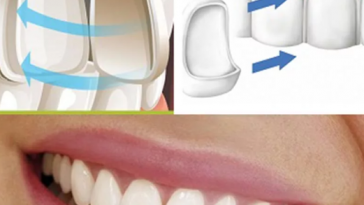 Виниры на Зубы: Улучшение Улыбки с Легкостью 6