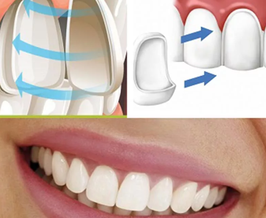 Виниры на Зубы: Улучшение Улыбки с Легкостью 2