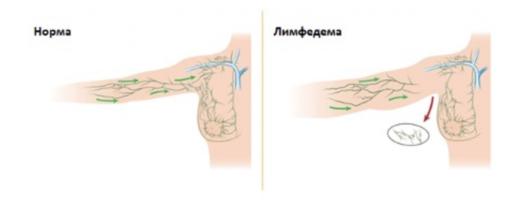 Для чего нужны компрессионные рукава при лимфедеме? 1