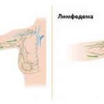 Для чего нужны компрессионные рукава при лимфедеме? 16