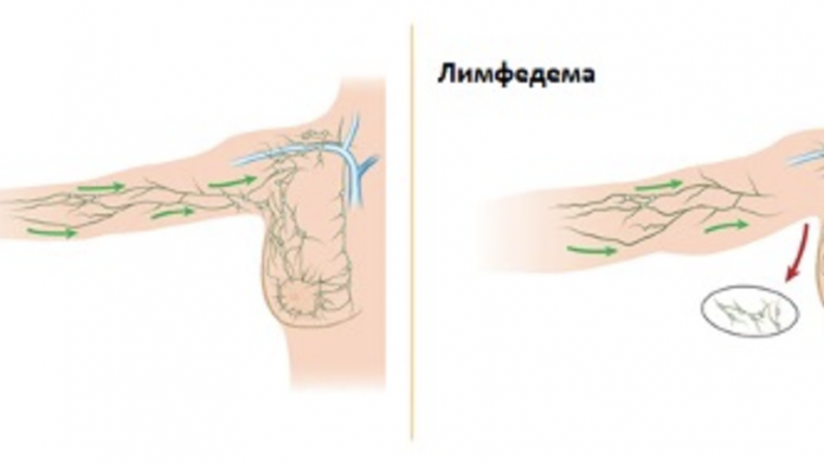 Для чего нужны компрессионные рукава при лимфедеме? 2