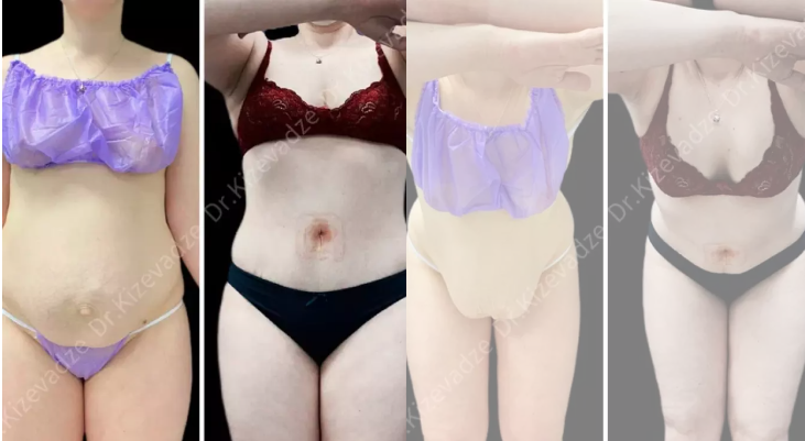 Абдоминопластика живота: сущность процедуры, показания, этапы и современные подходы 2